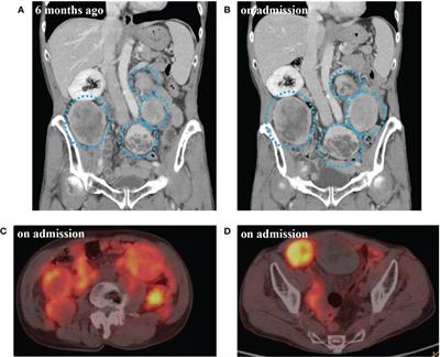 Big insulin-like growth factor 2-producing multiple solitary fibrous tumors treated with debulking surgery: A case report